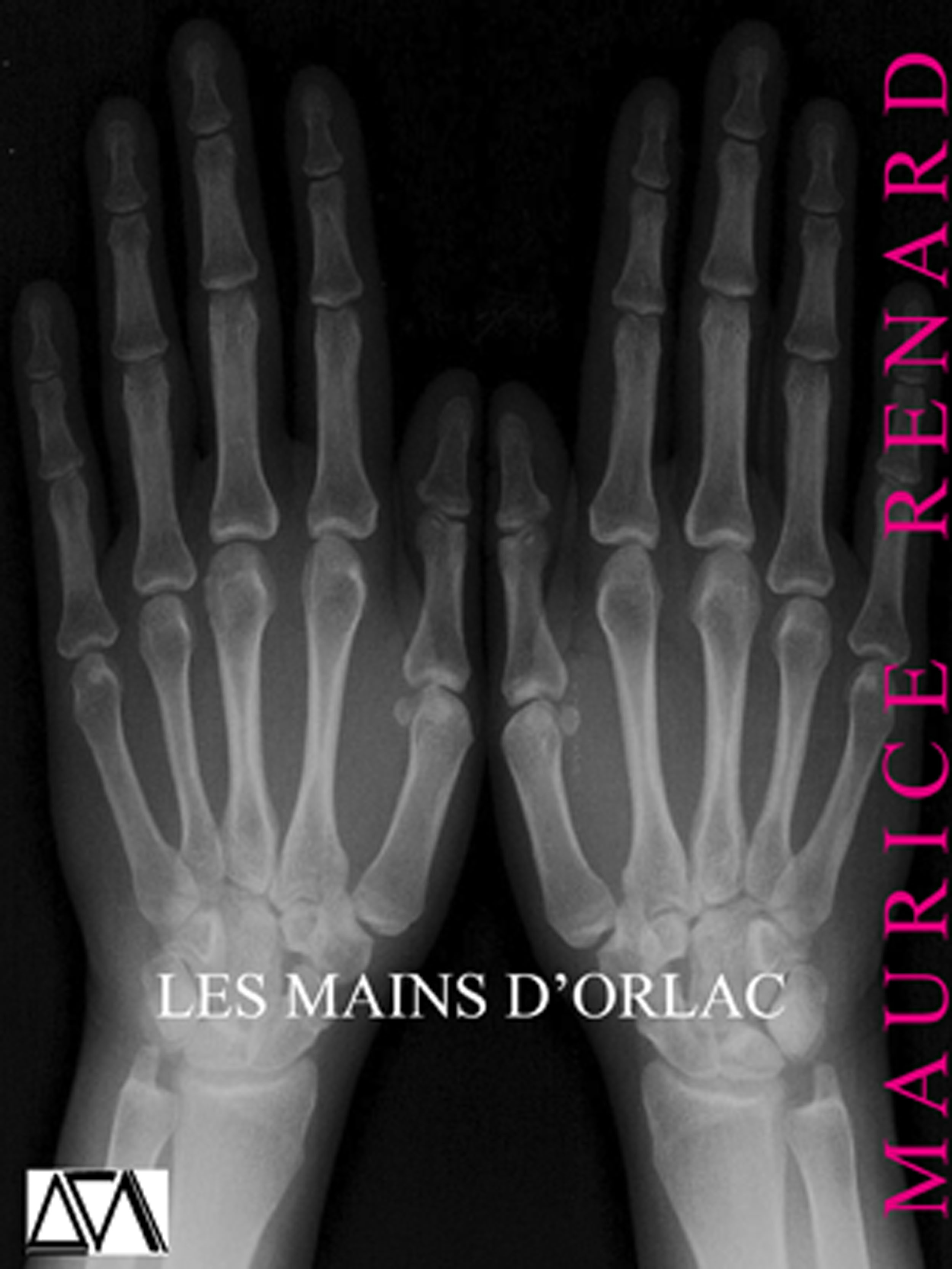 ebook cover of Les Mains d'Orlac, by Maurice Renard