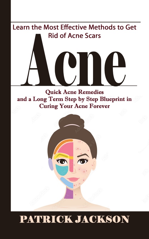 Couverture ebook de Acne: Learn the Most Effective Methods to Get Rid of Acne Scars (Quick Acne Remedies and a Long Term Step by Step Blueprint in Curing Your Acne Forever), de Patrick Jackson